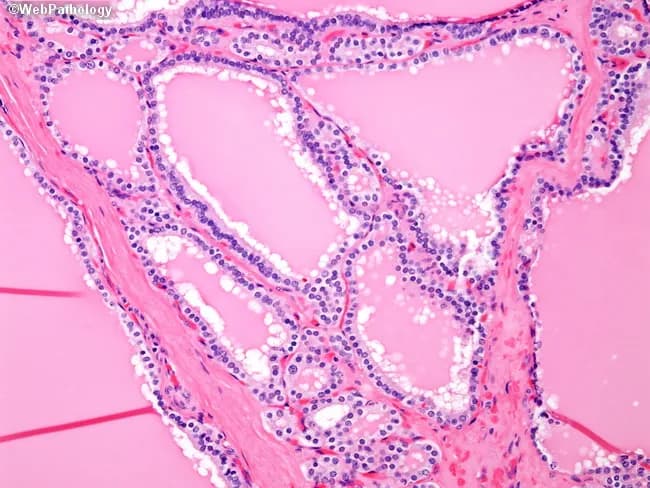 Imaging modality: Light microscopy of thyroid tissue stained with Hematoxylin and Eosin (H&E), magnification approximately 200x. Anatomic source: thyroid gland in the neck with diffuse follicular architecture preserved. Visual features: enlarged follicles containing pale, eosinophilic colloid with scalloped margins; tall, hyperplastic follicular epithelium and mild to moderate papillary infolding are evident. The colloid scalloping results from ongoing colloid resorption driven by thyrocyte hyperactivity. Overall, the gland demonstrates diffuse goiter with uniform follicular hyperplasia and increased vascularity. Pathologic interpretation: autoimmune hyperthyroidism consistent with Graves disease; stimulation by thyroid-stimulating immunoglobulins leads to TSH receptor activation and increased thyroid hormone production (T3/T4). Clinical significance: histologic picture supports autoimmune etiology and helps differentiate Graves disease from other causes of thyrotoxicosis, such as toxic multinodular goiter or thyroiditis; the absence of focal adenomas supports a diffuse process. Normal variants: none relevant. Differential considerations: toxic multinodular goiter (nodular, irregular follicles), subacute thyroiditis (inflammatory infiltrate). Clinical correlation: correlate with serum TSH, free T4, T3, anti-TSH receptor antibodies, and clinical symptoms (weight loss, heat intolerance, weakness, ophthalmopathy). This image is valuable for educational teaching, histopathology references, and research on autoimmune thyroid disease. Correlative imaging data and molecular studies can enhance diagnostic precision.