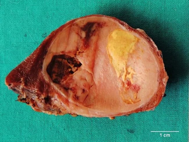 Grossly, this is a macroscopic photograph of a partial thyroidectomy specimen showing a well-circumscribed, tan to light brown nodule with a distinct fibrous capsule. The cut surface reveals a solid lesion with encapsulation, containing areas of hemorrhagic transformation and cystic degeneration, and surrounding scar tissue. These features are typical of a long-standing follicular adenoma of the thyroid, a benign neoplasm composed of uniform follicular epithelium forming colloid-filled follicles separated from adjacent thyroid parenchyma by a capsule. The degenerative changes reflect chronicity; hemorrhagic and cystic changes may obscure small follicles on microscopic examination. The presence of a capsule and lack of gross invasiveness support benignity, though definitive distinction from follicular carcinoma requires microscopic assessment for capsular and vascular invasion. Clinically, the patient is euthyroid; management typically involves lobectomy or partial thyroidectomy with histologic confirmation. This image is valuable for education and research by illustrating gross-pathology correlations with histology in thyroid nodules and the spectrum of degenerative changes in benign thyroid neoplasms. The 1 cm scale bar is visible, enabling rough size estimation. Knowledge of such gross features helps in differential diagnosis, correlation with capsule integrity, and understanding how long-standing nodules evolve over time.