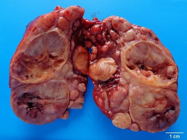 This gross pathology photograph documents a resected thyroid gland specimen, anterior view, with bilateral lobes separated for inspection. The background is a blue-friendly field and a 1 cm scale bar is present for size reference. The specimen displays multiple firm, tan to brown nodules replacing native thyroid parenchyma, with irregular contours and areas of marginal hemorrhage. The left and right lobes show expansion of the thyroid capsule, and prominent nodularity suggests follicular architecture disrupted by neoplastic growth. The caption indicates widely invasive follicular carcinoma of the thyroid, consistent with extrathyroidal extension and potential vascular invasion; gross features include invasion beyond the capsule and involvement of perithyroid soft tissue. No papillary nuclear features are assessable on gross inspection; histology would confirm follicular differentiation, capsular and vascular invasion, and tumor margins. Clinically, this specimen supports a diagnosis of aggressive differentiated thyroid carcinoma associated with higher risk of hematogenous metastasis. The imaging context is macroscopic pathology; the modality is gross photography used for documentation, education, and archival purposes. This image is relevant for surgical pathology education, thyroid cancer staging, case-based discussions, and radiologic-pathologic correlation exercises; useful for learners reviewing follicular thyroid carcinoma, aggressive variants, and the significance of extrathyroidal extension in prognosis.