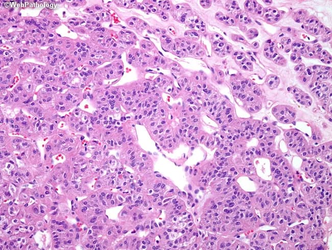 Low-power brightfield histology image of a paraffin-embedded liver biopsy stained with hematoxylin and eosin (H&E). Hepatic parenchyma demonstrates cords of polygonal hepatocytes separated by sinusoids. Cells show round to oval nuclei with finely dispersed chromatin and prominent nucleoli in a subset of nuclei. Cytoplasm is eosinophilic with variable intensity. Occasional binucleated hepatocytes are present. The plate architecture appears relatively preserved with intact sinusoidal networks; no widespread steatosis or bile stasis is evident at this field. No obvious portal triad congestion or inflammatory infiltration is conspicuous; however, a few small portal tracts appear in the economy of the field. The image emphasizes cellular morphology rather than a discrete neoplastic lesion, making definitive diagnosis of hepatocellular carcinoma or benign mimics challenging without immunohistochemistry and clinical data. This slide is suitable for educational purposes to illustrate hepatocyte cytology, binucleation, and sinusoidal arrangement, and to discuss differential diagnoses in hepatocellular lesions. Clinically, if a focal hepatic mass or chronic liver disease is suspected, this histology would be integrated with radiologic imaging and serology to determine whether a malignant tumor, benign lesion, or regenerative nodular disease is present. Further immunostains and clinical correlation are recommended for definitive classification and management planning in suspected tumors. Notes.