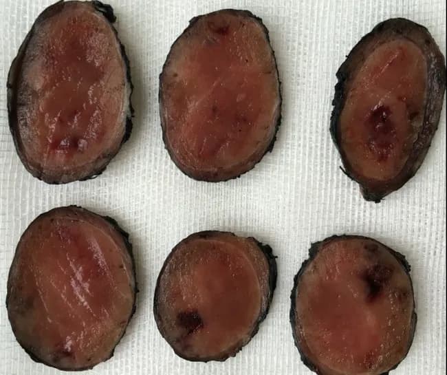 Gross image of six transverse sections from excised thyroid tissue representing Hurthle cell adenoma (oncocytic adenoma) of the thyroid gland. Modality: clinical gross pathology photography; specimen: thyroid nodules; orientation: macroscopic cross-sectional slices laid in a grid on a neutral background for documentation. The nodules exhibit well-defined, encapsulated margins with a uniform to slightly variegated tan-to-reddish cut surface. Capsular integrity appears preserved in most slices, consistent with a benign, noninvasive follicular lesion; occasional focal hemorrhagic or fibrous creases are present. The tissue demonstrates abundant eosinophilic cytoplasm in Hurthle cells (oncocytic change) at the gross level, though microarchitectural features cannot be resolved without histology. The image is intended to aid gross-pathology assessment and surgical pathology correlation, supporting the differential diagnosis of Hurthle cell adenoma versus Hurthle cell carcinoma and other thyroid follicular lesions such as follicular adenoma or nodular hyperplasia. Clinically, this finding is relevant to surgical planning, thyroid function assessment, and malignancy risk stratification; final classification relies on microscopic capsular and vascular invasion status. This depiction may be used in educational contexts to illustrate gross nodularity, encapsulation, and the appearance of Hurthle cell-containing thyroid adenomas. Educational use: suitable for medical students and residents encountering thyroid pathology. Correlates with histology, radiology reference.