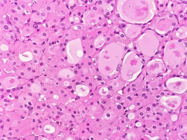 Histology image of Hurthle cell adenoma of the thyroid. This light microscopy slide is stained with Hematoxylin and Eosin (H&E) and shows a predominantly oncocytic (Hurthle) cell population arranged in sheets and microfollicular clusters. The cells are large and polygonal, with abundant granular eosinophilic cytoplasm rich in mitochondria, and round to oval nuclei with often prominent nucleoli. Nuclei may display mild atypia, but mitotic activity is scarce in this field. The lesion appears typically well circumscribed and encapsulated within thyroid parenchyma, with a benign architectural pattern; no definite invasive cords are evident in this view. Colloid material may be scant or variably present within trapping follicles. The surrounding stroma is modest, and vessels are not overtly infiltrated by tumor cells in this image. Clinically, Hurthle cell adenoma represents a benign neoplasm of uncertain function that can simulate carcinoma on cytology; therefore capsule integrity and absence of capsular or vascular invasion are essential for definitive classification. This image is instrumental for histopathology education, differential diagnosis with Hurthle cell carcinoma, and surgical planning discussions, and it supports terminology including oncocytic adenoma, Hurthle cell lesion, and thyroid follicular neoplasm. Further education and clinical correlation.