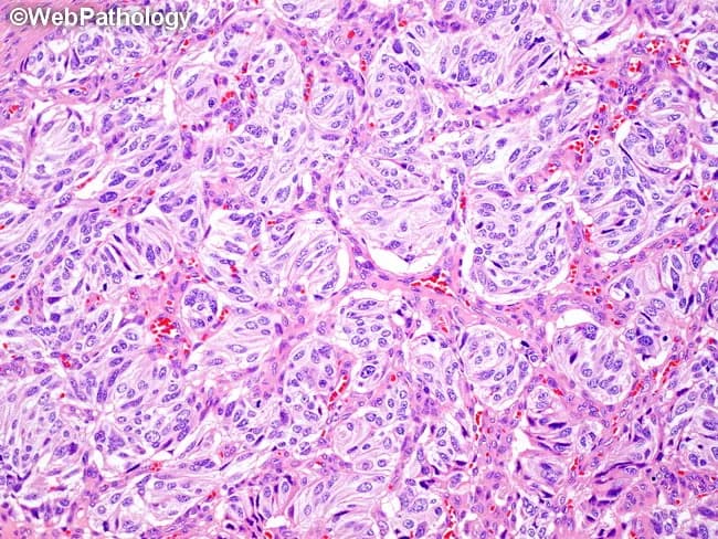 A histopathologic image of pancreatic tissue demonstrates a well-differentiated neuroendocrine tumor (pNET) with solid nests arranged in a paraganglioma-like, zellballen pattern. The material is stained with Hematoxylin and Eosin and viewed under light microscopy. The pancreas is the organ of origin, within the digestive/endocrine system. Tumor cells form cohesive nests and cords, separated by delicate vascular stroma, producing an organoid architecture. Within nests, cells are uniform, polygonal to round, with moderate eosinophilic cytoplasm and round to oval nuclei showing characteristic salt-and-pepper chromatin. Nuclear size is relatively uniform; mitotic figures are infrequent in a low to mid-grade lesion. Background pancreatic parenchyma may show minimal desmoplastic reaction. The overall pattern mimics paraganglioma due to nested arrangement, but clinical context and immunophenotype (not shown) would support pancreatic neuroendocrine differentiation with chromogranin A and synaptophysin positivity and a low to intermediate Ki-67 index. This histology has diagnostic significance for grading, prognosis, and surgical planning, and it informs differential considerations against paraganglioma, solid pseudopapillary neoplasm, and ductal adenocarcinoma. Clinically relevant uses include guiding endocrine evaluation, localization prior to resection, and inclusion in educational resources on pancreatic neuroendocrine neoplasms and nest-like patterns in gastroenterology and pathology curricula.