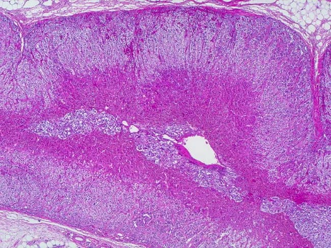 Imaging modality: Light microscopy; Technique: Hematoxylin and Eosin (H&E) stained paraffin section showing adrenal gland architecture. Adrenal gland composed of an outer cortex with three concentric zones—zona glomerulosa (outermost), zona fasciculata, and zona reticularis—surrounding an inner medulla with chromaffin cells; in this low-power view the medulla is centralized and encircles the principal blood vessels near the image center. The cortex thickness measures approximately 1 mm in healthy adults and demonstrates dense cellular cords with alternating light and dark staining patterns corresponding to zona fasciculata foamy cytoplasm and zona glomerulosa compact arrangement; zona reticularis forms a network of intertwining cords. The medullary region consists of chromaffin cells arranged in irregular clusters with abundant cytoplasm and consistent purple nuclei; scant interstitial connective tissue is visible. The overall architecture is preserved, with no evident cortical hyperplasia, nodularity, or adrenal neoplasm. The specimen likely represents a normal, non-pathologic adrenal gland from a healthy adult, matching reported averages: combined gland weight ~8 g and normal cortex thickness ~0.7–1.3 mm. Diagnostic significance: confirms typical zonation and corticomedullary organization; pathology considerations would include hyperplasia, adenoma, pheochromocytoma if architecture were disrupted. Clinical correlation: adrenal function tests, cortisol/aldosterone regulation, catecholamine synthesis would be interpreted against this baseline.