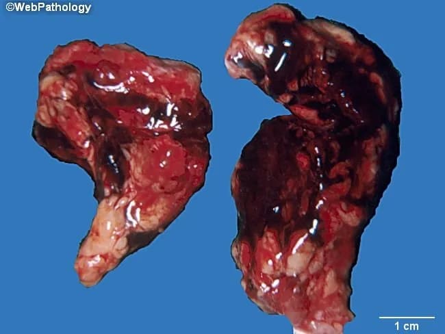 Gross pathology photograph of bilateral adrenal glands exhibiting massive hemorrhagic adrenalitis consistent with Waterhouse-Friederichsen syndrome. This specimen derives from fulminant septicemia, most classically meningococcemia, but adrenocortical hemorrhage also occurs with pneumococcal and other bacterial sepsis. The two suprarenal glands are markedly enlarged, with dark red to brown hemorrhagic parenchyma replacing the normal tan cortex and medulla. The capsules appear thin and disrupted in places, and surface friability and liquefactive necrosis may be present. The scale bar in the image indicates a centimeters-scale size, with each gland roughly a few centimeters in maximal dimension, underscoring bilateral involvement. The lesions show confluent hemorrhage extending through the cortex with extensive edema and tissue loss, consistent with acute adrenal insufficiency if the hemorrhage is bilateral. Clinically, Waterhouse-Friderichsen syndrome signals adrenal crisis, shock, hyponatremia, hyperkalemia, and possible death without prompt steroid replacement and septic source control. Histopathology, if examined, would likely reveal adrenocortical hemorrhage with necrosis, hemorrhagic stroma, and inflammatory infiltrates corresponding to disseminated intravascular coagulation. This image is valuable for medical education, pathology atlases, and differential diagnosis discussions of acute adrenal hemorrhage due to septicemia. Potential applications include teaching gross morphology of adrenal hemorrhage, correlating gross findings with clinical adrenal insufficiency, and highlighting emergency management in fulminant infection.