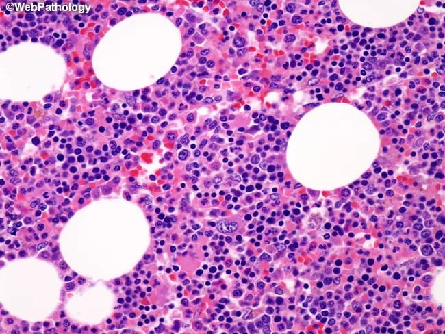This histopathology image depicts a bone marrow component embedded within an adrenal myelolipoma. The marrow shows preserved trilineage hematopoiesis, consisting of erythroid, myeloid, and megakaryocytic lineages, in a normal morphological spectrum. Notably, there is an increased number of megakaryocytes, distributed singly and in small clusters, without overt dysplasia or abnormal mitotic figures. The hematopoietic elements appear well-differentiated with typical chromatin pattern and nuclear morphology; there is no significant crowding or fibrosis evident at the margins of the field. Adipose tissue elements characteristic of myelolipoma interdigitate with hematopoietic elements, consistent with a benign composite lesion rather than marrow failure or infiltrative malignancy. The image is stained with Hematoxylin and Eosin and examined under light microscopy; cells show dark purple nuclei (hematopoietic precursors) against pink-orange cytoplasm and pale adipocytes in the background. Clinically, such a finding indicates retained marrow activity within the adrenal lesion and does not in itself imply a systemic myeloproliferative disorder. Correlate with complete blood count, platelets, JAK2 mutation status if hematologic neoplasm is suspected, and radiologic assessment to differentiate from extramedullary hematopoiesis or malignant infiltration. These findings emphasize the benign nature of the marrow component within adrenal myelolipoma and aid histopathologic differentiation from marrow-related malignancies in diagnostic practice.