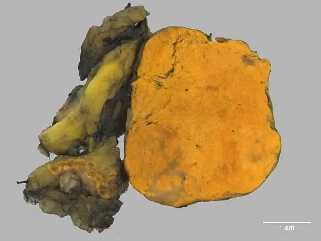 Gross pathology image of a unilateral adrenal gland resection specimen showing a well-circumscribed, golden-yellow cortical adenoma measuring approximately 3 cm in greatest dimension. The tumor is encapsulated and demonstrates a homogeneous, lipid-rich appearance typical of adrenal cortical adenomas; the surrounding adrenal cortex is partially compressed. Coloration is characteristic of lipid-rich adenomatous tissue with a bright yellow/orange hue. The surface contour appears smooth with minimal necrosis or hemorrhage. This macroscopic phenotype aligns with an aldosterone-producing adenoma, a common cause of primary hyperaldosteronism (Conn syndrome) accounting for about 70% of cases; some adenomas are small to moderate in size and may exhibit a lipid-dense cut surface that contrasts with non-neoplastic cortex. The image’s scale bar indicates 1 cm, supporting a lesion size near 3 cm. Clinically, excess aldosterone leads to potassium loss with hypokalemia, sodium retention, hypertension, and suppression of plasma renin activity; a thorough evaluation of the renin-angiotensin-aldosterone axis and radiologic assessment of both adrenals is essential. In cases of benign adenoma, surgical resection is often curative. Differential considerations include adrenal cortical hyperplasia and, less commonly, adrenal cortical carcinoma or pheochromocytoma, though macroscopic appearance and size favor adenoma. Correlation with hormonal studies and postoperative improvement supports the diagnostic conclusion.