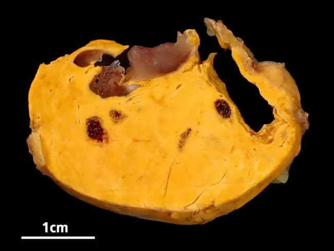Gross pathology photograph of a suprarenal gland showing an adrenal cortical adenoma with focal myelolipomatous change. The specimen presents a well‑circumscribed, lobulated, bright yellow cortical mass with scattered dark brown to burgundy gelatinous foci representing myelolipoma components. The yellow adipocytic tumor contrasts with the darker, nonlipomatous areas; a cross section reveals a heterogeneous cut surface with preserved capsule and occasional fibrous septa. The architecture is consistent with a benign adrenal cortical neoplasm containing adipose tissue and hematopoietic elements within myelolipomatous foci. Myelolipomas are typically nonfunctional and incidental but may accompany adenomas; their presence does not imply malignancy. Pathologic correlation suggests a nonfunctioning or minimally functioning adrenal cortical adenoma with incidental myelolipomatous change. Clinically, this image is relevant for educational references on adrenal incidentalomas, differential diagnosis (myelolipoma versus liposarcoma or cortical carcinoma), and gross confirmation prior to histology. Potential diagnostic uses include teaching radiologic–pathologic correlation, gross morphology description, and surgical pathology workflow. This specimen demonstrates how macroscopic features guide sampling for histology and how adipose tissue with hematopoietic elements appears within an adrenal cortical tumor, aiding recognition of myelolipomatous change. The 1 cm scale bar in the accompanying image provides size context for tumor dimensions and pathologic assessment and educational value.