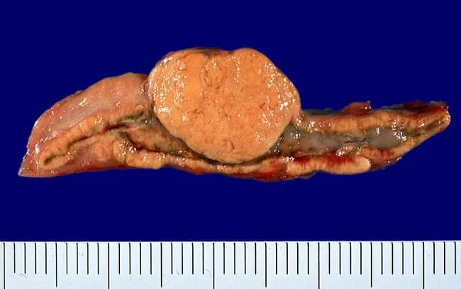 Gross pathology photograph of an excised human adrenal gland displaying a solitary, sharply circumscribed, yellow cortical adenoma arising from the adrenal cortex. The tumor presents as a discrete, well-demarcated nodule with a smooth capsule, contrasting against a relatively thickened surrounding cortex. The cut surface is homogeneous, lipid-rich, and tan-yellow, characteristic of adrenal cortical adenomas, reflecting abundant intracellular lipids. The mass measures approximately a few centimeters in diameter. The rest of the adrenal cortex shows mild concentric thickening or hyperplasia adjacent to the lesion. The adrenal medulla appears gray and well preserved. No hemorrhage or necrosis identified. The specimen is consistent with a benign cortical lesion associated with Conn syndrome, a form of primary hyperaldosteronism. This macroscopic appearance supports aldosterone-secreting adenoma; differentiation from cortisol-producing adenomas, pheochromocytoma, or adrenal cortical carcinoma requires histology and immunohistochemistry. Clinically, such adenomas present with hypertension, hypokalemia, metabolic alkalosis, and suppressed renin. The gross features are crucial for surgical pathology documentation and correlate with preoperative biochemical hyperaldosteronism. This image is useful for educational illustration of adrenal adenoma morphology, gross differential diagnosis, and surgical consideration in endocrine hypertension.