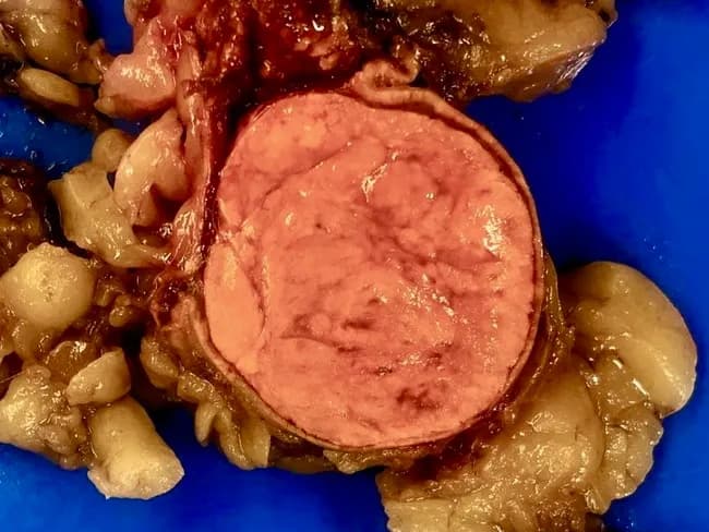 Comprehensive Description: This gross pathology photograph depicts an adrenal gland tumor, a 5.2 × 4.6 cm, round, well-circumscribed adrenal cortical adenoma, excised from a young adult male. Modality: macroscopic gross specimen photography of a fresh surgical specimen with standard lighting. Anterior-midline transsection reveals a golden yellow cut surface, characteristic of lipid-rich adrenal cortical tissue, surrounded by a thin rim of preserved yellow adrenal cortex. The tumor appears homogeneous, with minimal fibrous septation and no evident necrosis or hemorrhage. The color and texture reflect lipid-rich steroidogenic cells typical of aldosterone-producing adenomas. The lesion is solitary and encapsulated within the adrenal cortex, without overt invasion into periadrenal fat. Size corresponds to 5.2 cm in the greatest dimension, consistent with clinically significant adenoma in young patients. This pathology supports primary hyperaldosteronism (Conn syndrome) if functionally active, commonly presenting with hypertension, hypokalemia, and metabolic alkalosis; however, operation and histology would be definitive. Differential considerations include adrenocortical adenoma versus carcinoma; size, circumscription, and lipid-rich greenish-yellow appearance favor adenoma. This specimen may be used for teaching gross anatomy, endocrinology, urology, and surgical pathology, with correlation to immunohistochemistry if available (CYP11B2/aldosterone synthase). Correlation with hormonal assays and preoperative imaging is essential for definitive diagnosis and surgical planning.