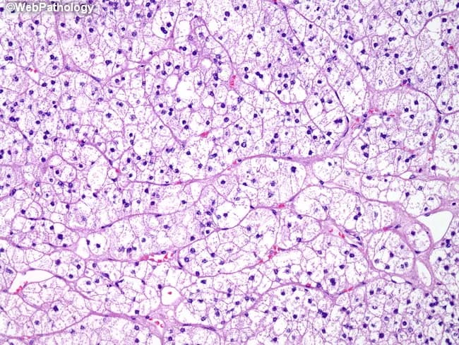 Light microscopic histology image of liver tissue stained with Hematoxylin and Eosin (H&E). The sample shows hepatic parenchyma arranged in broad cords separated by prominent sinusoids. The cytoplasm of many hepatocytes appears markedly pale or clear due to intracellular lipid accumulation, consistent with macrovesicular steatosis. Nuclei are scattered throughout each cell, often displaced toward the cell periphery, reflecting lipid droplet expansion. The overall architecture remains preserved without convincing lobular inflammation, Mallory-Denk hyaline, or confluent necrosis at this magnification. Portal tracts are not prominent in this field, suggesting midzonal or hepatocellular predominance of the fatty change. Capillarization of sinusoids or mild vascular congestion is not conspicuous. The pattern is compatible with fatty liver changes, which can be seen in nonalcoholic fatty liver disease (NAFLD), alcoholic fatty liver disease, or other etiologies of steatosis. Clinically, these findings correlate with metabolic syndrome, obesity, type 2 diabetes, or excess alcohol intake. The image provides educational value for recognizing macrovesicular steatosis and distinguishing it from other hepatocellular pathologies such as steatohepatitis, viral hepatitis, or cholestasis. This histology is essential for diagnosing hepatic steatosis and guiding further metabolic or lifestyle interventions. Correlation with patient history and imaging enhances diagnostic confidence and guides management and follow-up care.