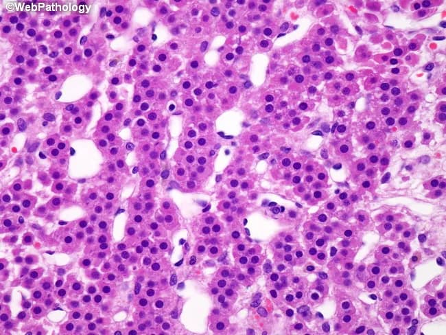 High-magnification brightfield histology of liver tissue stained with hematoxylin and eosin. The hepatic parenchyma displays preserved lobular architecture with cords of polygonal hepatocytes separated by narrow to wide sinusoids. A prominent feature is diffuse intracellular lipid accumulation, manifested as numerous clear cytoplasmic vacuoles that displace occasional nuclei to the cell margin. Both macrovesicular and microvesicular fat droplets are evident, creating a foamy to bubbly cytoplasmic appearance in many hepatocytes. The overall pattern is hepatocellular steatosis; there is no conspicuous bridging necrosis or lobular inflammation visible in this field, though mild cytoplasmic swelling of some hepatocytes can be appreciated. Bile ducts and portal tracts appear unremarkable in this view. The appearance is compatible with fatty liver changes, seen in nonalcoholic fatty liver disease (NAFLD) or alcoholic fatty liver disease, and may reflect metabolic syndrome, insulin resistance, or hepatotoxic exposure. Clinically, such steatosis can be reversible with weight reduction, glucose control, and avoidance of hepatotoxins. Pathologic significance lies in assessing the degree of steatosis and distinguishing simple steatosis from steatohepatitis, which would warrant closer clinical management. This image is suitable for educational reference in hepatology, pathology, and diagnostic imaging.