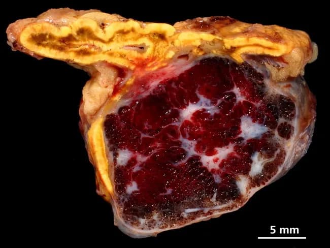 Gross pathology image of an adrenal gland specimen showing a sharply demarcated, rounded, spongy lesion arising within the suprarenal gland. The cortex appears yellow and finely lobulated, surrounding a central, reddish-brown, multi-lobulated mass with conspicuous vascular spaces and areas of hemorrhagic slippage. The surface cut reveals a well-circumscribed lesion with a spongy, sponge-like consistency and a heterogeneous color pattern from bright crimson to dark purplish red, interspersed with white fibrous septa. The margin between the lesion and adjoining adrenal cortex is distinct, consistent with a benign vascular neoplasm. The lesion corresponds to cavernous hemangioma, a vascular malformation characterized by large, dilated blood-filled vascular channels separated by scant stroma. The pathogenesis is related to dilatation of venous channels and thin endothelial linings; histology would demonstrate cavernous, irregular vascular spaces lined by flat endothelium. Final diagnosis: cavernous hemangioma of the adrenal gland. Notable features include well-demarcated borders, spongy gross morphology, and a reddish interior reflecting high vascular content. Clinically, such adrenal vascular tumors are rare and may be incidentalomas; definitive diagnosis relies on histopathology. This specimen is documented for educational reference in gross pathology and for correlation with radiologic and histologic findings. Potential clinical uses include teaching, differential diagnosis of adrenal masses, and study of adrenal pathology.