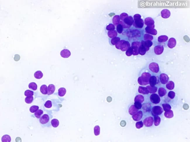 This is a Wright–Giemsa stained bone marrow aspirate smear imaged by bright-field light microscopy at high magnification, showing a cytology-level field of hematopoietic cells. Nuclei are round to irregular with coarse chromatin; cells range from mature myeloid/erythroid elements to immature precursor forms. Clusters of cells and occasional smearing artefacts reflect aspirate preparation. Staining emphasizes nuclear detail and cytoplasmic basophilia, enabling assessment of lineage commitment, maturation, cellularity, and potential neoplastic involvement. The image is clinically relevant for evaluating marrow cellularity, dysplasia, and infiltration, and for distinguishing reactive hematopoiesis from malignant processes. Diagnostic significance lies in guiding ancillary studies such as flow cytometry, cytogenetics, and molecular testing. Potential educational and diagnostic applications include hematopathology training, differential diagnosis of acute leukemia and myelodysplastic syndrome, aplastic anemia evaluation, and assessment of marrow involvement by lymphoma. Clinically, correlate with CBC, differential counts, peripheral smear, and immunophenotyping to determine prognosis and treatment planning. Interpretation should consider sample quality and ancillary data to ensure accurate diagnosis.