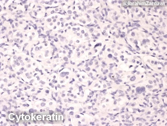 This is a histology image from formalin-fixed paraffin-embedded tissue stained by Cytokeratin immunohistochemistry and counterstained with hematoxylin, viewed under brightfield light microscopy. The tissue section reveals numerous rounded to polygonal cells with oval to eccentric nuclei, inconspicuous cytoplasm, and a diffuse cellular distribution set against a pale connective tissue background. Cytokeratin positivity highlights epithelial components within the specimen, enabling delineation of epithelial lineage amidst possible non-epithelial elements. The staining pattern supports epithelial differentiation and helps distinguish carcinomatous epithelium from lymphoid or mesenchymal neoplasms in diagnostic workflows. Observed features include uniform to mildly pleomorphic nuclear morphology, occasional nucleoli, and a generally cohesive cellular arrangement with minimal mitotic activity suggested by the micrographs. The image is most relevant to pathology and oncology; it is commonly used to confirm epithelial origin in suspected carcinomas, to characterize metastatic disease, or to support grading and staging processes in conjunction with additional markers (CK7, CK20, p40, CK5/6). Clinically, CK IHC informs tumor typing, guides treatment planning (surgery, chemotherapy, radiotherapy), and contributes to prognostic assessment. This slide is a representative educational example for students and clinicians studying cytokeratin-based identification of epithelial tumors. This description emphasizes search-relevant terminology for histology, immunohistochemistry, and epithelial tumors.