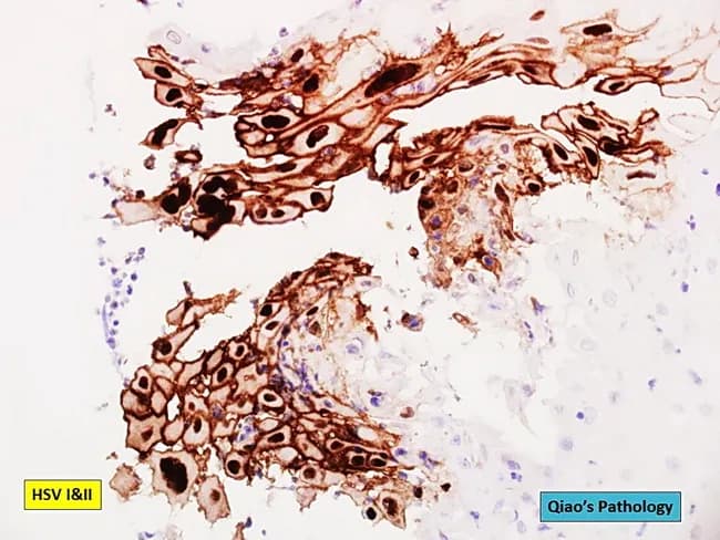 Histology with immunohistochemistry for herpes simplex virus (HSV-1/HSV-2) applied to an esophageal ulcer biopsy. The specimen shows mucosal ulceration with loss of epithelial integrity and dense inflammatory infiltrate in the underlying lamina propria. Numerous infected squamous epithelial cells exhibit classic cytopathic effects, including multinucleation, nuclear enlargement and prominent eosinophilic intranuclear inclusions (Cowdry type A). The HSV immunostain labels the infected cells with a brown chromogen, delineating scattered and clustered positive cells throughout the lesion. Adjacent noninfected mucosa demonstrates preserved architecture with basal cell hyperplasia and regenerative changes. In some areas, ballooning degeneration and acantholysis contribute to the desquamation of epithelial cells. The stain is specific for HSV-1/HSV-2 and supports a diagnosis of herpes esophagitis, especially when clinical context includes immunosuppression or underlying mucosal damage. Background inflammatory cells include lymphocytes and plasma cells; occasional neutrophils are present in ulcer craters. The morphological pattern helps distinguish from cytomegalovirus infection, which typically shows large cells with prominent owl's eye inclusions, and from candidal infection, which reveals fungal organisms on special stains. Thus HSV immunostaining provides definitive confirmation and guides antiviral therapy. Correlation with patient symptoms, serology, and endoscopic findings improves diagnostic confidence and informs antiviral management, isolation precautions, and monitoring for complications such as bleeding or perforation.