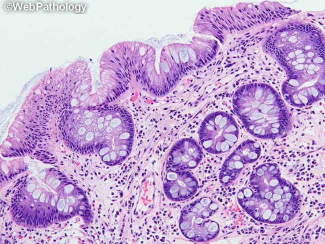 This histology slide demonstrates Barrett esophagus at the distal esophagus with intestinal metaplasia characterized by replacement of native squamous epithelium by columnar mucosa containing goblet cells. The specimen is prepared as a standard paraffin-embedded tissue section and stained with Hematoxylin and Eosin for routine morphological assessment. Under light microscopy, the mucosal surface reveals columnar epithelium arranged in irregular glands and foci of goblet cells with mucin-filled cytoplasm and pale staining. Goblet cells appear as rounded to oval cells with clear lumens, embedded within a fibromuscular lamina propria that contains a chronic inflammatory infiltrate. The underlying basal cell layer shows preserved architecture with minimal dysplasia in this field; there is no overt invasion or ulceration. The transition zone between squamous mucosa and intestinal-type mucosa is evident, consistent with Barrett esophagus. Clinically, BE is a premalignant condition linked to an increased risk of low- to high-grade dysplasia and esophageal adenocarcinoma, making histologic confirmation of goblet cell–containing metaplasia critical for diagnosis in many regions (e.g., United States, Germany) where goblet cells define specialized intestinal mucosa. This image is foundational for pathology education, differential diagnosis with reflux esophagitis, GERD-associated mucosal changes, and BE surveillance planning.