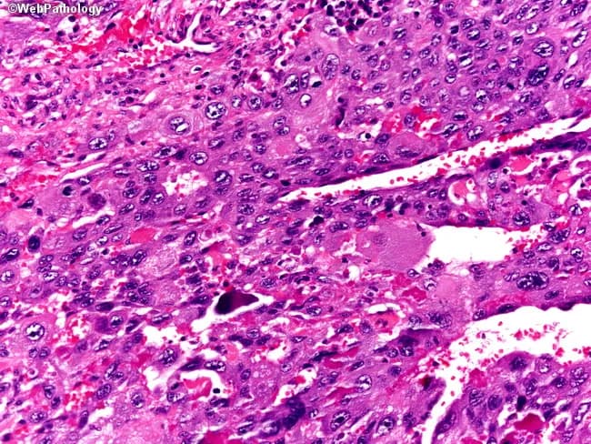 Histology: Formalin-fixed Barrett esophagus biopsy examined by light microscopy. The section is stained with Hematoxylin and Eosin (H&E). It shows a biphasic trophoblastic tumor consisting of cytotrophoblasts admixed with prominent syncytiotrophoblastic giant cells in a hemorrhagic background. The cytotrophoblasts are round to polygonal, with vesicular nuclei, indistinct cytoplasmic borders, and mild to moderate pleomorphism; mitotic activity may be evident. The syncytiotrophoblastic giant cells display abundant cytoplasm, multinucleation, and marked nuclear variability, creating a characteristic multinucleated syncytial pattern. There is extensive hemorrhage and occasional necrotic foci within the lesion, with nests and sheets of tumor cells infiltrating the esophageal mucosa and extending into the submucosa in an irregular, infiltrative fashion. In the Barrett context, this represents choriocarcinomatous differentiation in an esophageal lesion, an unusual but documented association. The differential diagnosis includes squamous cell carcinoma, adenosquamous carcinoma, neuroendocrine carcinoma, and sarcomatoid carcinoma, among others. Clinically, such histology carries implications for prognosis and therapy, often prompting systemic treatment regimens aligned with gestational trophoblastic disease or mixed esophageal carcinomas, in conjunction with endoscopic and imaging staging. Immunohistochemistry, when performed, commonly demonstrates trophoblastic markers (e.g., hCG) supporting the diagnosis. This image highlights biphasic trophoblastic differentiation and hemorrhagic context critical for accurate, timely diagnosis.