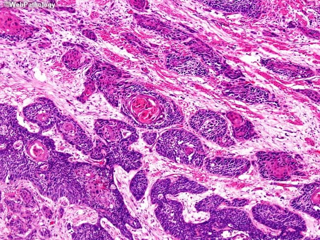 This histopathology image depicts esophageal squamous cell carcinoma, using brightfield light microscopy on an H&E-stained tissue section. The lesion is located in the mid-to-lower esophagus, consistent with common anatomical distribution of esophageal squamous cell carcinoma in males over 50. The tumor shows nests and cords of malignant squamous cells with sharp borders, abundant eosinophilic cytoplasm, intercellular bridges, and keratin pearl formation, reflecting a well-differentiated phenotype. The surrounding stroma exhibits desmoplastic reaction with inflammatory infiltrates. Individual tumor cells display relatively mild atypia given the differentiation, though mitotic figures may be present at higher magnification. Invasion into the submucosa and muscularis propria is evident in places, indicating advanced local disease despite the well-differentiated histology. These histologic features align with classic radiographic and clinical patterns: progressive dysphagia, weight loss, chest pain in some cases, and late presentation. Risk factors include tobacco use, alcohol consumption, prior caustic ingestion (lye), achalasia, Plummer-Vinson syndrome, and prior radiation. Pathologic assessment informs prognosis and staging, guiding therapeutic decisions such as neoadjuvant therapy, esophagectomy, or definitive chemoradiation. This image serves educational and research purposes for pathology, oncology, and gastroenterology to study squamous differentiation, keratinization, and local invasion patterns in esophageal cancer. Correlates with staging and multidisciplinary treatment planning today.