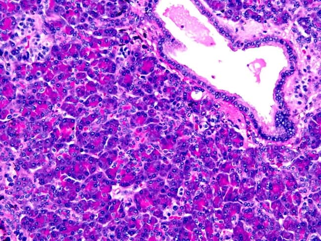 Histology image of ectopic pancreas within the gastric wall. Acinar cells with granular eosinophilic cytoplasm form pancreatic acini adjacent to ductal structures; islets of Langerhans appear as lighter, rounded cell clusters. The specimen demonstrates Heinrich type I ectopia, containing all pancreatic elements (acini, ducts, islets) embedded in gastric tissue, with preserved lobular organization and intervening gastric mucosa. The micrograph is stained with Hematoxylin and Eosin, highlighting basophilic nuclei and eosinophilic cytoplasm; acini display zymogen granules, ductal epithelium lines small ducts, and endocrine islets are dispersed in the exocrine pancreas. The lesion is a congenital anomaly presenting in the stomach, usually incidental but clinically relevant for differential diagnosis of submucosal gastric lesions. Diagnostic significance lies in recognizing heterotopic pancreatic tissue to avoid misdiagnosis as gastric neoplasm or inflammatory process. Potential clinical use cases include educational reference for surgical pathology, gastroenterology differential diagnosis, and radiologic-pathologic correlation. This image illustrates the histomorphology of ectopic pancreas, enabling recognition of all pancreatic components within gastric tissue and supports discussion of Heinrich classification, ectopic pancreas prevalence, and associated clinical scenarios such as pancreatitis or obstruction when symptomatic. The image thereby serves as a reference for teaching, diagnostic reasoning, and histopathological correlation in gastrointestinal pathology and education.