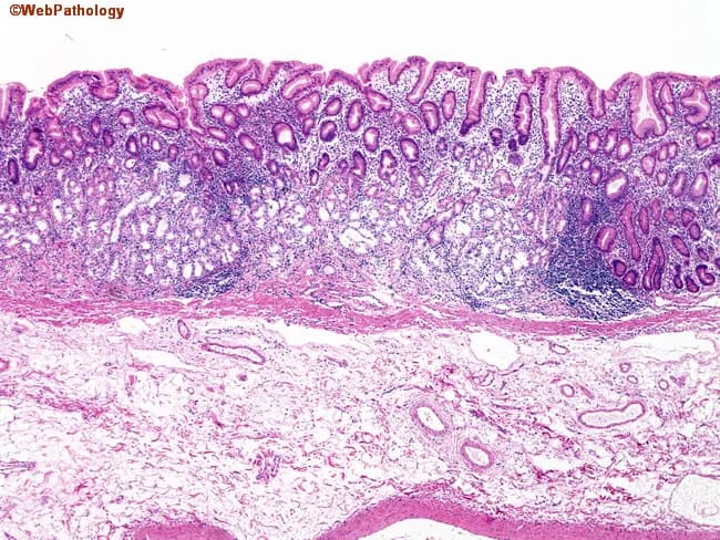 This histopathology image depicts a gastric mucosa biopsy from the fundic/corpus region examined under light microscopy after hematoxylin and eosin staining. The specimen demonstrates prominent thinning of the fundic mucosa with loss of oxyntic/parietal cells, consistent with gastric mucosal atrophy. The lamina propria is densely infiltrated by lymphocytes and plasma cells (lymphoplasmacytic infiltrate), typical of autoimmune gastritis. Glandular architecture is attenuated; residual fundic glands appear irregular with cystic dilatation and foveolar hyperplasia may be absent. The submucosa and deeper layers appear relatively uninvolved in this field. The morphological pattern, characterized by corpus-predominant atrophy and parietal cell loss, supports an autoimmune process rather than Helicobacter pylori gastritis, though correlation with endoscopy and serology is essential. Clinically, such histology implies hypochlorhydria/achlorhydria and potential pernicious anemia risk due to intrinsic factor deficiency, guiding further workup (gastrin levels, autoantibodies, B12 status). This image serves as a representative teaching example for pathology of autoimmune gastritis, highlighting key features: parietal cell depletion, mucosal atrophy, dense plasma cell rich inflammation, and the need to verify site of origin for biopsy through endoscopic correlation. Potential clinical applications include diagnostic validation, educational case discussion, and research on corpus-predominant atrophic gastritis.