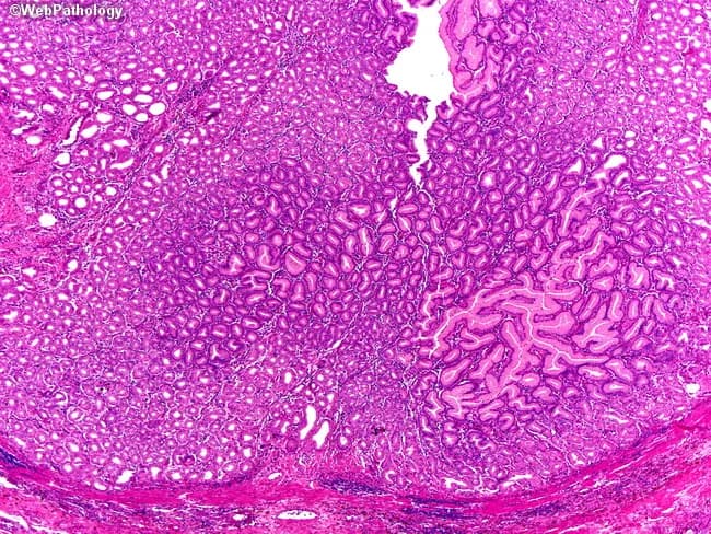 This image shows gastric body mucosa obtained by biopsy, examined under light microscopy with standard Hematoxylin and Eosin staining. The histologic hallmark is marked foveolar hyperplasia with elongated, tortuous glands and frequent cystic dilatation of mucous glands, a pattern strongly suggestive of hypertrophic gastropathy. The surface epithelium is mucin-rich, with tall, columnar foveolar cells forming crowded, branching pits; deep oxyntic glands are variably atrophic in affected foci. Lamina propria is mildly edematous and may contain modest chronic inflammatory infiltrates. The overall architecture is diffuse rather than polypoid, consistent with a non-neoplastic, hyperplastic process. No definite dysplasia is observed in this field; however, Menetrier-type hypertrophic gastritis (Menetrier disease) carries a recognized risk of gastric adenocarcinoma with time. The pattern correlates clinically with adult-onset, often severe disease characterized by diffuse thickening of the gastric folds and protein-losing enteropathy, whereas pediatric forms are typically self-limited. On this section, the combination of foveolar hyperplasia, gland tortuosity, and cystic dilation constitutes the diagnostic clue. This histology supports a diagnosis of Menetrier-type hypertrophic gastropathy and has implications for management, including monitoring for nutritional deficiency, edema, and potential neoplastic transformation, and consideration of EGFR-targeted therapies in selected patients.