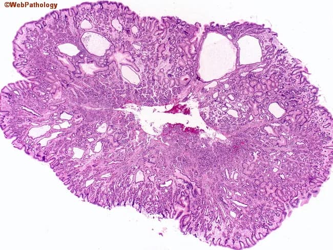 Imaging modality: Histopathology with light microscopy of a gastric mucosa biopsy. The slide shows a polypoid proliferation in the gastric body/fundus region composed of cystically dilated fundic glands embedded in fibromuscular lamina propria. The epithelium lining these glands is largely atrophic with minimal inflammatory change, and there is preservation of mucous foveolar cells around the periphery. The glands are variably sized, with round to elongated lumina, and the overall architecture is organized without destructive invasion. No dysplasia or neoplastic transformation is evident. Background mucosa lacks significant Helicobacter pylori-associated gastritis. The glands demonstrate oxyntic differentiation, characterized by parietal and chief cell-rich acini, consistent with fundic gland polyps. The lesion is localized and nonpedunculated; surface epithelium is intact. Clinically, fundic gland polyps are usually small (<2 cm) and benign; sporadic and syndromic forms exist, the latter associated with familial cancer syndromes and requiring tailored surveillance. The diagnostic significance is that these features distinguish fundic gland polyps from inflammatory or neoplastic gastric polyps, reducing immediate oncologic concerns but mandating appropriate clinical-follow-up per syndrome status. In differential diagnosis, consider gastric hyperplastic polyps, adenomas and inflammatory polyps. This image is educational for pathology residents illustrating typical fundic gland polyp histology and the benign behavior in non-syndromic cases.