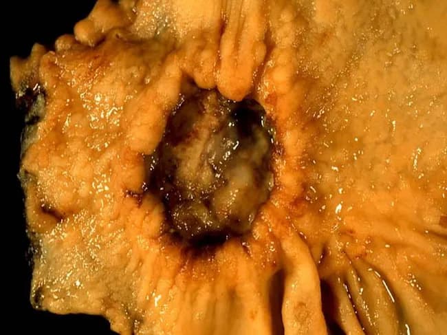 This gross pathology photograph documents a subtotal gastrectomy specimen from a 40-year-old female with abdominal pain. The gastric wall at the anterior aspect exhibits marked thickening and rigidity with a central ulcer crater on the lesser curvature. The lesion is firm and tan-yellow with irregular, serpiginous margins and surrounding diffusely involved mucosa. The pyloric margin is oriented to the left, consistent with distal stomach resection. The thickened wall and ulceration are characteristic of diffuse-type gastric carcinoma, particularly signet ring cell carcinoma, which classically produces diffuse infiltration (linitis plastica pattern) and loss of normal gastric rugal folds. While histology confirms signet-ring cells with intracellular mucin and nuclear displacement, gross assessment emphasizes wall stiffening and circumferential spread rather than a discrete mass. The clinical history notes a biopsy-proven signet ring cell carcinoma, and this resection aims to relieve obstruction and achieve cytoreduction. In diffuse gastric cancer, involvement of the prepyloric region and lesser curvature correlates with pyloric obstruction risk and poor prognosis; subtotal gastrectomy provides palliation and potential survival benefit in selected cases. This image is educational for surgical pathology, illustrating tumor localization, wall thickening, ulceration, and gross patterns of diffuse gastric malignancy, and can support differential diagnoses such as linitis plastica vs focal mucosal ulcerating carcinoma in teaching cases.