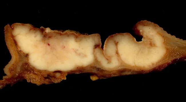 Gross pathology photograph of a gastric wall longitudinal section demonstrating infiltrative adenocarcinoma with diffuse wall thickening. The specimen shows the stomach cut along its greater curvature, with the duodenal margin at the left, allowing assessment of tumor extension across the pyloric region. The tumor invades deeply, producing marked, irregular luminal distortion and a diffuse, leathery thickening consistent with linitis plastica. The mucosa appears variably pale and fibrotic, with firm, white-tan tumor tissue intermingled with submucosal fat and serosa. Histologically, the described subtype is signet ring cell carcinoma, characterized by tumor cells with intracytoplasmic mucin pushing the nucleus to the periphery, resulting in cells with a signet-ring appearance; this pattern accounts for the diffuse infiltration and stiffness. The lesion lacks clear circumscribed mass and instead permeates through wall layers, explaining the poor prognosis associated with diffuse-type gastric cancer. Clinically relevant implications include aggressive behavior, early transmural spread, and potential involvement of regional lymphatics. This image is useful for education on gross morphology of diffuse gastric adenocarcinoma, signet-ring cytology, and to illustrate differential considerations such as intestinal-type carcinoma, lymphoma, or inflammatory processes. Documentation notes: image courtesy of Ed Uthman, MD, Houston, Texas. Clinical note: correlates with gross pathology findings and surgical planning.