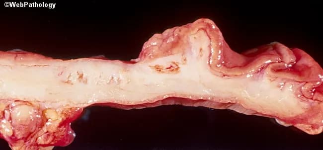 This is a gross pathology photograph of a gastric wall segment from a surgical resection, illustrating diffuse tumor infiltration consistent with signet ring cell carcinoma of the stomach. Imaging modality: gross pathology photography; specimen is a stomach/gastric wall section oriented longitudinally to reveal the mural involvement. The gastric wall is markedly thickened and firm, with a pale, tan to gray appearance and irregular, cobblestoned surface; there is minimal discreet tumor mass, reflecting a diffuse infiltrative growth pattern. The lesion corresponds to the diffuse-type gastric adenocarcinoma (signet ring cell) and demonstrates linitis plastica–like remodeling of the gastric wall, with infiltration extending from mucosa through submucosa and muscularis propria. Histologic subtype: signet ring cell carcinoma characterized by mucin-filled cells with peripherally displaced round nuclei, often discohesive, producing diffuse spread rather than a mass-forming lesion. Clinically, this pattern is associated with aggressive behavior, early transmural spread, and poor prognosis. Diagnostic significance: confirms gastric malignancy type as diffuse signet ring cell carcinoma; supports staging workup, prognosis assessment, and therapeutic planning (gastrectomy with lymphadenectomy and systemic therapy). Potential clinical use cases include education on diffuse gastric cancer morphology, gross-pathology correlation, and radiologic-pathologic correlation for linitis plastica presentations.