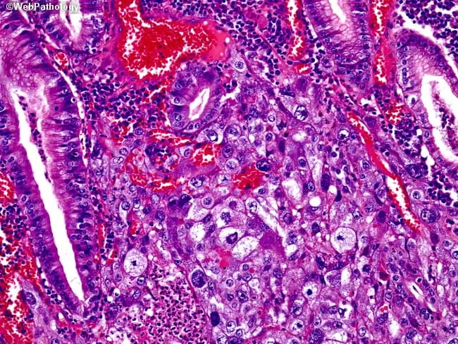 This histopathology slide shows a gastric carcinoma with choriocarcinomatous differentiation. Hematoxylin and eosin stained tissue from the stomach demonstrates a biphasic neoplasm: conventional adenocarcinoma glands forming malignant epithelial elements intermingled with a focal trophoblastic component composed of cytotrophoblasts (polygonal cells with distinct borders and vesicular nuclei) and intermediate trophoblasts arranged in sheets and nests. The trophoblastic component invades the gastric mucosa and submucosa; there is frequent hemorrhage and areas of necrosis; tumor cells show marked pleomorphism and mitotic activity. The histology is identical to gonadal choriocarcinoma, lending support to the diagnosis of primary gastric choriocarcinoma arising in association with adenocarcinoma; serum beta-hCG levels are typically elevated in patients with trophoblastic differentiation. Immunohistochemistry would reveal positivity for HCG in the trophoblastic cells, with cytokeratin expression in the adenocarcinoma component. Clinically, this entity portends an extremely poor prognosis and aggressive behavior, necessitating prompt systemic therapy and careful tumor staging to exclude metastatic germ cell disease. This image is relevant for pathology education, differential diagnosis in gastric tumors, and studies of trophoblastic differentiation in non-gestational contexts. Potential use cases include diagnostic pathology review, teaching slide collections, and research into gastric choriocarcinoma biology, trophoblastic markers, and therapeutic targeting.