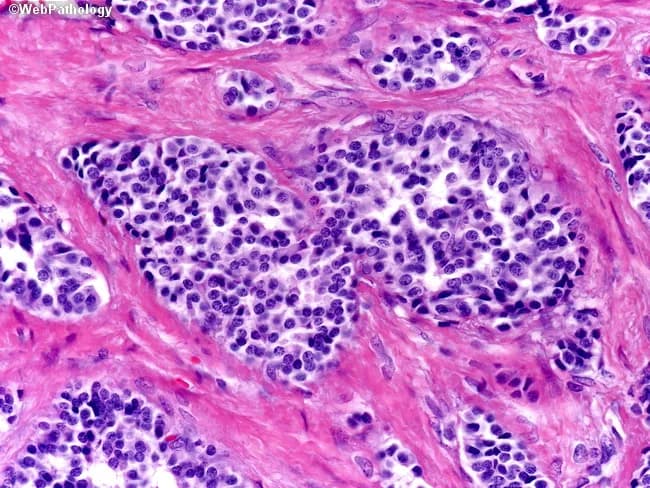 Histopathology image of a gastroenteropancreatic neuroendocrine tumor (gastrinoma) evaluated on hematoxylin and eosin stain. The tumor is composed of uniform nests and cords of neuroendocrine cells embedded in dense fibrous stroma with conspicuous fibrous septa. Cells are polygonal with round to oval nuclei and granular (salt-and-pepper) nuclear chromatin; cytoplasm is moderate to scant, with low mitotic activity. Architectural pattern shows cohesive clusters separated by desmoplastic stroma rather than mucosal nodules with tightly packed trabeculae and acini typical of Type 2 gastrinomas. In this case the desmoplastic reaction may contribute to firm, fibrous tissue surrounding tumor nodules. Immunohistochemistry (not shown) would commonly be positive for chromogranin A and synaptophysin, supporting neuroendocrine differentiation, and gastrin production in clinically suspected Zollinger-Ellison syndrome or MEN1. Clinically, gastrin-secreting tumors cause hypergastrinemia, peptic ulcers, and refractory ulcers; they are part of the MEN1 spectrum. Pathologic differential includes well-differentiated neuroendocrine tumor versus poorly differentiated neuroendocrine carcinoma and pancreatic ductal adenocarcinoma with desmoplasia; architectural and cytologic features favor NET. The image highlights important diagnostic clues: neuroendocrine cytology, uniform cell morphology, nesting patterns, and desmoplastic stroma, guiding clinical correlation and management. This histologic pattern informs prognosis, surgical planning, and consideration of somatostatin receptor-targeted therapies in NETs. Moreover, it guides clinical management.