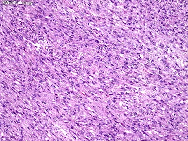 This is a light-m microscopy histopathology image of a gastrointestinal stromal tumor (GIST) in spindle cell form. The tissue shows spindle-shaped cells arranged in broad fascicles within a loose to moderate stroma. Nuclei are elongated with minimal pleomorphism and cytoplasm is eosinophilic to lightly basophilic; mitotic figures may be scarce in the depicted field. The overall pattern is classic for spindle cell GIST, which arises from interstitial cells of Cajal and can differentiate along smooth muscle or neural lines, though the image itself does not display immunohistochemical markers. Clinically, GISTs are most commonly located in the stomach or small intestine and require confirmation with immunostains such as KIT (CD117) and DOG1; CD34 is variably positive. The diagnostic significance lies in distinguishing GIST from other spindle cell GI tumors (e.g., leiomyosarcoma, schwannoma). Differential diagnoses include leiomyosarcoma, schwannoma, desmoid-type fibromatosis, and fibrosarcoma. Once confirmed, treatment typically involves surgical resection with adjuvant/targeted therapy guided by mutation status (e.g., imatinib for KIT/PDGFRA mutations). This image is relevant for educational discussions of GIST histology, spindle cell morphology, and differential diagnosis in GI pathology.