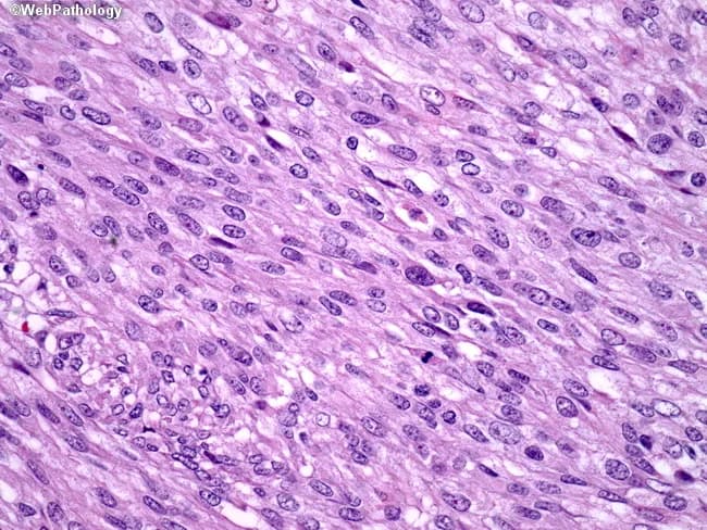 This is a high-magnification histopathology image of a gastrointestinal stromal tumor (GIST) showing a spindle cell-dominant morphology. Tissue is examined by light microscopy after Hematoxylin and Eosin staining, at ×400 magnification, highlighting elongated, fusiform cells arranged in intersecting fascicles with ovoid to elongated nuclei and eosinophilic cytoplasm. The stroma appears fibrous to lightly myxoid, with preserved cellular detail and minimal necrosis in this field. The spindle cell population is characteristic of many GISTs and supports a mesenchymal neoplasm of the gastrointestinal tract. In clinical practice, GISTs commonly harbor activating mutations in the c-KIT (CD117) gene in about 80% of cases or in PDGFRA (~8%), leading to constitutive tyrosine kinase signaling. Immunohistochemical CD117 positivity is a key diagnostic surrogate; DOG1 is frequently positive and may aid in challenging cases. Accurate molecular testing for c-KIT and PDGFRA mutations informs prognosis and eligibility for targeted therapy with tyrosine kinase inhibitors such as imatinib. This image serves as a reference for recognizing spindle cell GIST histology, differentiating it from smooth muscle or neural tumors, and illustrating how morphology guides ancillary testing, mutation profiling, and therapeutic decision-making in gastroenterology oncology and surgical pathology. This education-oriented caption emphasizes diagnostic workflow and targeted therapy implications for practice.
