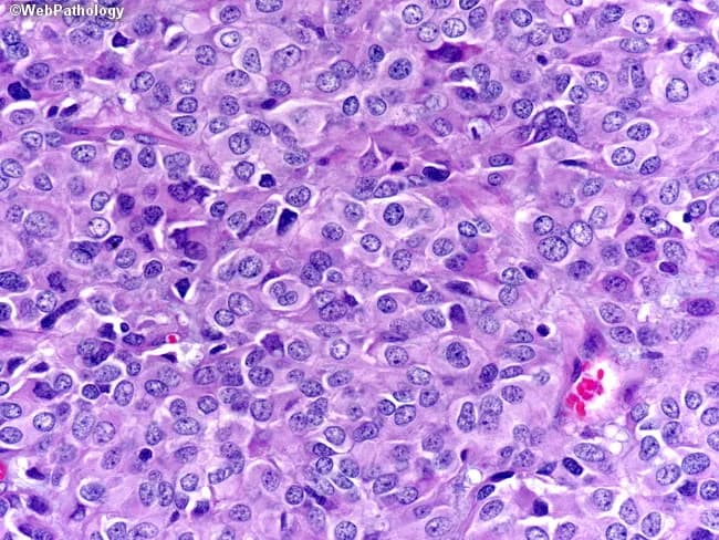 Histology image acquired by bright-field microscopy of a gastrointestinal stromal tumor (GIST), epithelioid variant, in a high-power field after hematoxylin and eosin staining. The tumor shows high cellularity with sheets and nests of round to polygonal epithelioid cells, abundant eosinophilic to clear cytoplasm, and conspicuous nucleoli. Nuclear crowding and marked pleomorphism are evident, with occasional mitotic figures noted at this magnification. The cells are separated by a delicate to moderate amount of hyalinized stroma and exhibit a relatively uniform, cohesive architecture despite cellular pleomorphism; there is minimal necrosis and no evident keratinization. This epithelioid morphology can closely resemble epithelioid carcinomas or melanoma, contributing to a broad differential diagnosis. In practice, immunohistochemical profiling (e.g., CD117/c-KIT, DOG1 positivity; cytokeratins and melanocytic markers typically negative) is essential to confirm GIST and exclude carcinoma or melanoma. Clinically, epithelioid GISTs may present in the stomach or small intestine and can be associated with activating KIT or PDGFRA mutations; prognosis depends on tumor size, mitotic rate, and location, impacting management with surgical resection and targeted therapy (imatinib). This image illustrates the histopathologic challenge of distinguishing epithelioid GIST from metastatic melanoma or epithelial malignancies on routine H&E, underscoring the need for ancillary testing in diagnostic workflows today.
