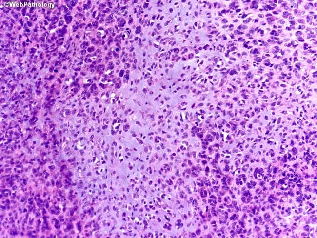 This histology image depicts a gastrointestinal stromal tumor (GIST) in a hematoxylin and eosin stained tissue section. The slide shows background myxoid matrix with focal decreased cellularity, a feature more common in epithelioid GISTs than spindle cell GISTs. Tumor cells are arranged in clusters within a loose, mucoid stroma; epithelioid-appearing cells with round to polygonal nuclei and eosinophilic cytoplasm predominate in the myxoid zones, while denser cellular areas display spindle-shaped cells. The intercellular network includes a delicate capillary network, and mitotic figures are variable, often scarce in myxoid regions but may be present in denser tumor nests. Such myxoid change can complicate histologic interpretation and broaden the differential to other myxoid mesenchymal neoplasms (myxoid leiomyosarcoma, schwannoma, liposarcoma); confirmation with KIT (CD117) and DOG1 immunostains and KIT/PDGFRA mutational analysis is recommended. Clinically, recognizing this histologic variant supports tumor localization within the GI tract, influences risk stratification, and informs targeted therapy decisions (imatinib). The image emphasizes the spectrum of GIST architecture, including myxoid stroma, variable cellularity, epithelioid morphology, and the necessity for ancillary testing to establish a definitive diagnosis and guide management. These features have implications for prognosis and response to therapy. Ancillary testing, including immunohistochemistry and mutational profiling, is essential.