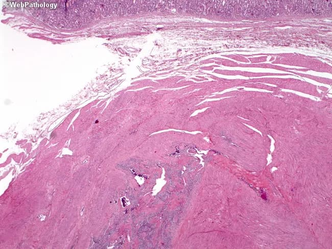 This histology slide displays gastric wall tissue with mucosa at the superior aspect and deeper muscularis propria beneath. A discrete neoplastic lesion resides within the muscular layers, visible near the bottom center as basophilic aggregates embedded in smooth muscle bundles. The lesion morphology is compatible with a glomus tumor (glomangioma) of the stomach, characterized by nests or sheets of uniform, round to polygonal cells with pale to eosinophilic cytoplasm surrounding slit- or vesicular vascular channels. The surrounding stroma is fibromuscular with conspicuous vasculature; the tumor shows a well-circumscribed architecture without frank pleomorphism, high-grade atypia, or conspicuous mitotic figures in this field. The overlying mucosa is intact. In this setting, immunohistochemistry is helpful: glomus tumor cells typically express smooth muscle actin (SMA) and vimentin, and are negative for desmin and CD117 (c-KIT) to distinguish from GIST or smooth muscle tumors. The differential for a submucosal gastric mass includes GIST, leiomyoma, hemangioma, paraganglioma, and neuroendocrine tumor; however, the perivascular arrangement and uniform cell population favor glomus tumor.