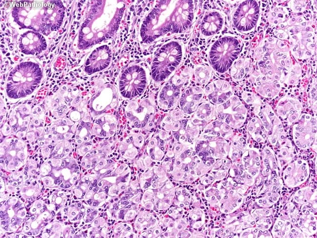 This is a high-magnification light microscopy image of gastric fundic mucosa (oxyntic glands) prepared with Hematoxylin and Eosin (H&E). The specimen represents stomach body/fundus mucosa; the image shows well-organized gastric tubular glands with prominent parietal (oxyntic) cells and abundant chief (zymogen) cells. Parietal cells appear as large, round to pyramidal cells with eosinophilic cytoplasm and intracellular canaliculi, often with a central or slightly eccentric nucleus, reflecting acid-secreting activity. Adjacent chief cells exhibit basophilic cytoplasm and basal nuclei; they contain apical zymogen granules. The glandular architecture demonstrates alternating parietal-rich regions and chief cell-rich zones within a single fundic unit, with supporting mucous cells and scattered enteroendocrine cells. The lamina propria shows a loose vascular stroma with scattered lymphocytes and capillaries; no acute or chronic inflammatory infiltrates are evident, and there is no dysplasia or metaplasia. This image captures histology suitable for educational references or diagnostic context as a normal comparator in gastritis, metaplasia, or neoplastic processes. Clinically, recognition of oxyntic glands and parietal/chief cell morphology under brightfield microscopy supports assessments of gastric acid secretion potential and helps differentiate fundic mucosa from antrum-type glands. The slide is useful for medical student teaching, histology atlases, and research focused on gastric gland physiology.