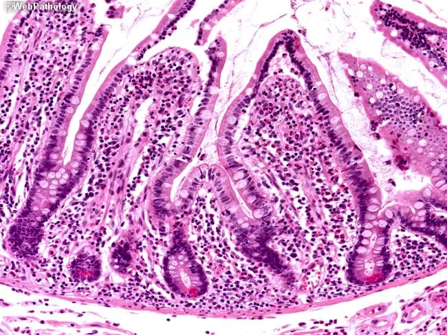 Imaging modality: Light microscopy of a hematoxylin and eosin (H&E) stained paraffin-embedded biopsy of small intestinal mucosa. The specimen reveals finger‑like villi projecting into the lumen, lined by tall simple columnar enterocytes with basally oriented nuclei and interspersed goblet cells. Crypts of Lieberkühn lie at the bases of the villi, forming closely packed glands within a fibrous lamina propria. The epithelium and lamina propria display preserved architecture without overt villous blunting, atrophy, or dysplasia. Nuclei are dark purple on hematoxylin; cytoplasm and extracellular matrix appear various shades of pink with eosin. Overall morphology is consistent with normal-appearing small intestinal mucosa, though subtle inflammatory cells may be present in the lamina propria depending on stage. This image demonstrates typical mucosal histology of the duodenum/jejunum region and is useful for assessing absorptive surface integrity and mucosal inflammation. Clinical relevance includes evaluation of malabsorption syndromes (celiac disease, tropical sprue, Giardia infection), inflammatory bowel disease involving the small intestine, and drug- or toxin-induced enteropathy. Diagnostic significance lies in verifying villous architecture and epithelial integrity, supporting differential diagnoses such as normal mucosa, chronic nonspecific enteritis, or villous atrophy when correlating with serology and symptoms. Educational value spans pathology, gastroenterology, and medical training.