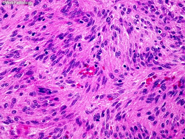 Imaging modality: Histopathology with bright-field light microscopy of a hematoxylin and eosin (H&E) stained section from a gastrointestinal tract neoplasm. Anatomic context: gastrointestinal tract wall (GI tract), smooth muscle tissue, muscularis propria region. Visual features: densely cellular fascicles of spindle-shaped cells with elongated, blunt-ended cigar-shaped nuclei and eosinophilic cytoplasm; minimal pleomorphism; absence of conspicuous mitotic figures within this field; variable stromal collagen and small, serpiginous blood vessels. The cells exhibit classic smooth muscle morphology consistent with leiomyosarcoma; adjacent areas elsewhere in the tumor may reveal higher mitotic activity and pleomorphism. Pathology: malignant neoplasm with smooth muscle differentiation; immunohistochemistry typically shows desmin and smooth muscle actin (SMA) positivity with h-caldesmon expression; in this field, morphological features strongly support leiomyosarcoma over benign leiomyoma or other spindle cell tumors such as GIST. Diagnostic significance: histology indicates a primary GI smooth muscle sarcoma; prognosis is influenced by mitotic rate, tumor size, necrosis, and location; clinical correlation includes surgical resection planning and potential adjuvant therapy; differential diagnoses include GIST, leiomyoma, fibrosarcoma, and sarcoma NOS. Potential clinical use: reference for tumor morphology in GI spindle cell neoplasms, educational cases in surgical oncology, pathology sign-out, and radiopathologic correlation in GI oncology.