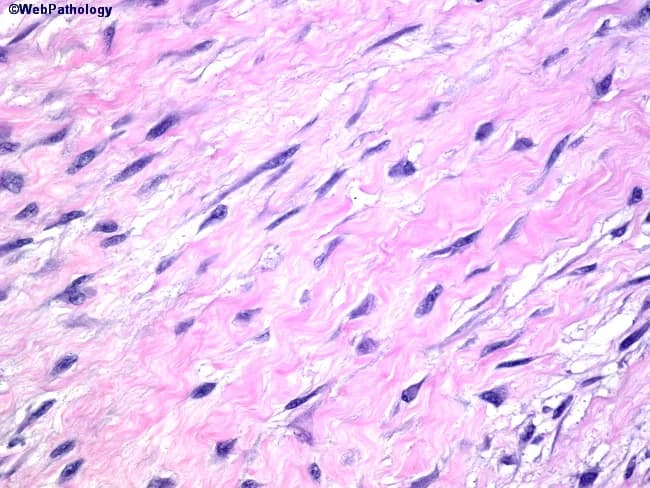 High-power light microscopy of a benign gastrointestinal stromal tumor (GIST) reveals spindle-shaped cells arranged in interlacing fascicles. The neoplastic cells are slender with occasional tapered ends and minimal cytoplasm, producing a homogeneous, eosinophilic background. Nuclei are elongated, with small, inconspicuous nucleoli and lack of pronounced nuclear waviness, pleomorphism, or hyperchromasia. The stroma is dominated by bland, eosinophilic collagen, and mitotic figures are not evident in the field, supporting a low proliferative activity. This spindle cell GIST subtype typically shows uniform cytology and cohesive fascicles, distinguishing it from schwannian or myogenic tumors, which may exhibit nuclear palisading or wavy nuclei. The absence of jagged nuclear contours or notable cytoplasmic vacuolization further supports a benign course in small lesions. Clinically, small GISTs are frequently asymptomatic and discovered incidentally during imaging or surgery. Immunohistochemical confirmation (CD117/c-KIT and DOG1 positivity) and mutational analysis (KIT or PDGFRA) are routinely pursued to establish diagnosis and guide risk stratification, though histology alone can strongly suggest GIST when classic spindle morphology is present. The image highlights diagnostic features relevant to surgical pathology, including tumor size, cellular blandness, and microenvironment, which influence management decisions and prognosis in gastrointestinal stromal tumors. This context supports accurate diagnosis and appropriate surgical planning.