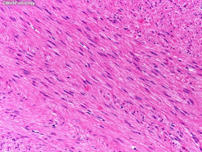 Histopathology: A formalin-fixed, paraffin-embedded tissue section stained with Hematoxylin and Eosin (H&E) shows interlacing fascicles of spindle-shaped smooth muscle cells with elongated, blunt-ended or cigar-shaped nuclei and abundant eosinophilic cytoplasm. The cells are uniform in size, with minimal nuclear atypia and rare mitotic figures; there is no evident necrosis. The architectural pattern is consistent with a benign leiomyoma arising from the smooth muscle layer, such as the muscularis propria of the gastrointestinal tract or uterine myometrium, depending on anatomic origin. Immunohistochemistry demonstrates tumor cells that are strongly positive for desmin and smooth muscle actin (SMA), confirming smooth muscle differentiation. The neoplastic cells are negative for gastrointestinal stromal tumor markers CD34, CD117 (c-KIT), and DOG1, effectively excluding GIST. Diagnostic significance: the combination of characteristic spindle cell morphology and desmin/SMA positivity with CD34/CD117/DOG1 negativity supports a diagnosis of leiomyoma over GIST or leiomyosarcoma. Clinical correlation: these lesions are typically benign with favorable prognosis following complete excision; differential diagnoses include leiomyosarcoma (increased mitotic activity, atypia, necrosis) and GIST (c-KIT or DOG1 positivity). This image exemplifies classical smooth muscle tumor histology and IHC profile, and is useful for educational purposes in surgical pathology, GI/hepatic pathology, and mesenchymal tumor differential diagnosis. Educational diagnostic utility.