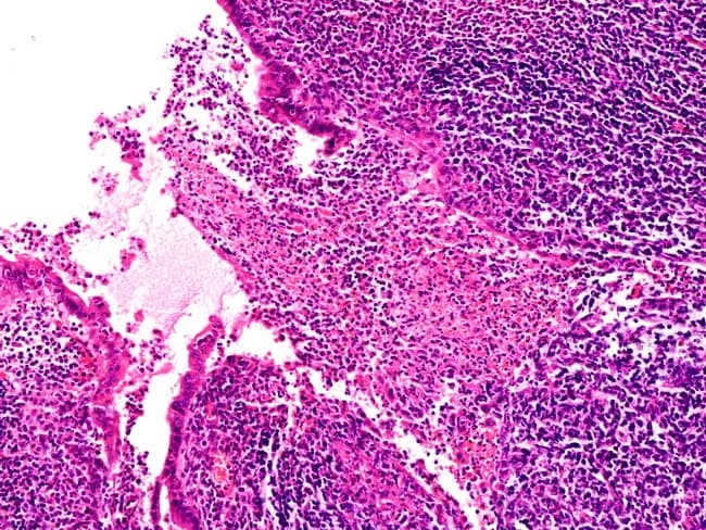 This histopathology image depicts appendiceal tissue at high magnification showing features of early acute appendicitis. Obtained from surgical appendix, the specimen is prepared as a hematoxylin and eosin (H&E) stained section and examined under light microscopy at high magnification (approximately 400x total). The specimen localizes to the vermiform appendix within the right lower quadrant, reflecting gastrointestinal tract anatomy. The mucosa and submucosa display focal neutrophilic infiltration with early cryptitis, subtle architectural distortion, and prominent interstitial edema. The inflammatory infiltrate is predominantly neutrophilic, with dense cellular clustering along the luminal margin and extending into the lamina propria, while goblet cells and overall glandular architecture remain relatively preserved in early disease. Vascular congestion and mild edema contribute to tissue pallor and fragility. No perforation or transmural necrosis is evident at this stage. These histological changes are typical of early inflammatory appendiceal pathology and support a clinical diagnosis of appendicitis when correlated with patient symptoms. Diagnostic significance: confirms early inflammation of the appendix and guides surgical management (appendectomy). Differential considerations include lymphoid hyperplasia-associated inflammation, infectious colitis, or secondary inflammatory responses. Clinically relevant use cases include educational reference, differential diagnosis training, pathology reporting, and correlation with radiologic imaging findings for teaching and research purposes.