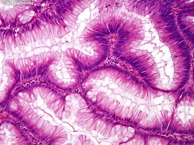 Imaging modality: brightfield light microscopy of a hematoxylin & eosin stained histology section from colorectal mucosa. Location: colorectal crypts within the mucosal layer of the large intestine (colon/rectum). The image shows high-magnification view (~400x) of tubular glands lined by tall columnar epithelial cells with basally located hyperchromatic nuclei. Nuclei appear elongated and densely staining (hyperchromasia) with preserved polarity in some regions and mild crowding in others. Goblet cells produce mucin and appear with pale cytoplasm interspersed among the epithelium. The gland lumina are irregularly shaped and show infolding and slight branching consistent with normal mucosal architecture, not overt neoplasia, though hyperchromasia can be a nonspecific reactive feature. The lamina propria contains minimal inflammatory cells; no frank desmoplasia, invasion, or significant mitotic activity is evident. These features are critical for diagnosing mucosal pathology, including evaluating for dysplasia or adenocarcinoma when clinical suspicion arises. Diagnostic significance: basally oriented nuclei are typical of healthy colorectal mucosa, but hyperchromasia and crowding require correlation with clinical data and additional sections. Potential clinical use cases include screening for colorectal neoplasia, assessment of mucosal inflammation, and educational reference for histopathology of the gastrointestinal tract. Additional note: correlate with endoscopic findings and patient history for definitive interpretation. Ultimately.
