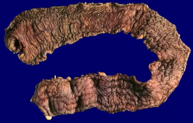 Gross photograph of a total colectomy specimen from a young male with ulcerative colitis showing pancolitis. The colon is laid flat, mucosal surface exposed, with diffuse hyperemia and irregular mucosal pattern. The mucosa displays multiple shallow and deeper ulcers with overlying pseudopolyps; the luminal contour remains relatively preserved except for mucosal edema. There is no appreciable wall thickening or stenosis; serosal surface appears smooth. The tissue demonstrates continuous inflammatory involvement along the entire colon, from cecum to rectum, without skip lesions, consistent with ulcerative colitis rather than Crohn disease. There are no discrete masses or signs of transmural inflammation; no perforation noted. The presence of pseudopolyps indicates chronic disease with mucosal regeneration. The external view shows a swollen, corrugated mucosal surface with corrugated transverse folds. The image is a macroscopic documentation suitable for gastroenterology and surgical pathology, useful for teaching, histologic correlation, and differential diagnosis between ulcerative colitis pancolitis and Crohn colitis, ischemic or infectious colitis. Clinically, this specimen supports a prognosis requiring colectomy due to refractory disease or dysplasia. The photograph provides a reference for pathology atlases and educational resources. Correlate with histology is essential for confirming ulcerative colitis versus Crohn disease and guiding patient management.