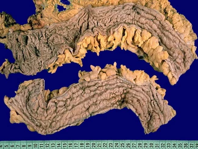 Comprehensive Description: Gross pathology photograph of a resected colon segment demonstrating Crohn disease (Crohn colitis). Modality: Gross external view of a macroscopic specimen; not microscopic imaging. Anatomic location: colon with terminal ileum involvement described; in this specimen, segments show transmural inflammation with deep longitudinal ulcers oriented horizontally; serpentine ulcers connected by short transverse ulcers; cobblestone mucosa due to pseudopolyps; mucosal edema and possible hemorrhage. Pathologic features: segmental, discontinuous involvement (skip areas) with sharp demarcation between diseased and normal mucosa; strictures from muscularis propria hypertrophy and fibrosis; long-standing disease produces luminal narrowing; fissures between mucosal folds; transmural inflammation may lead to perforation or fistula tracts; creeping fat may envelop the serosa in advanced disease. Digital imaging of external surface highlights creeping fat and mesenteric fat wrapping. Clinical significance: pattern helps differentiate Crohn disease from ulcerative colitis; transmural involvement, fissuring ulcers, and creeping fat correlate with fistulization and stricturing risk; surgical planning and prognosis are informed by gross features. Differential considerations include ulcerative colitis (continuous colitis) and intestinal tuberculosis; clinical correlation with radiologic and endoscopic findings is essential for accurate diagnosis and management. This image is valuable for surgical education, pathology training, and correlating gross features with imaging and histology in practice.