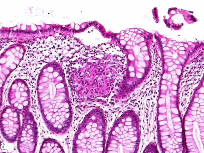 This high-quality histopathology image displays a colectomy specimen from Crohn disease, mounted on a slide and examined by light microscopy after hematoxylin and eosin (H&E) staining. The transverse section of colonic wall shows mucosa and submucosa with inflammatory changes, including chronic inflammatory infiltrate and fibrosis. In the center of the image, a well-formed non-caseating epithelioid granuloma is evident, composed of aggregates of epithelioid histiocytes with occasional multinucleated giant cells, surrounded by a rim of lymphocytes. The granulomatous focus may extend through multiple layers and can be encountered in inflamed or non-inflamed segments, and even in mesenteric lymph nodes as described in Crohn disease. The granulomas are non-necrotizing, which helps distinguish them from tuberculous granulomas. Adjacent tissue may show transmural involvement, fissuring ulcers, edematous stroma, and architectural distortion typical of Crohn disease. Importantly, granulomas are present in only about 40–60% of Crohn cases, so their absence does not exclude the diagnosis. Clinically, recognition of epithelioid granulomas supports diagnosis, informs differential with sarcoidosis and infectious granulomatous colitis, and correlates with transmural disease activity relevant for surgical planning and prognosis. This image is a valuable teaching resource for pathology, gastroenterology, and surgical pathology education.
