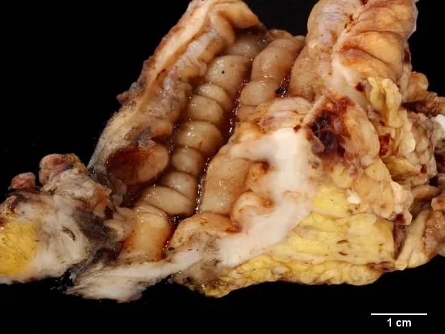 Gross pathology photograph of a sigmoid colectomy specimen from a young male with Crohn disease presenting with a colovesical fistula. The specimen is opened longitudinally to expose the colonic mucosa. The left lower quadrant bowel reveals a conspicuous fistulous tract extending medially toward the urinary bladder. The mucosal surface shows a cobblestone pattern with deep, irregular ulcers and fissuring along the length of the sigmoid colon, consistent with transmural Crohn disease. The serosa is thickened with creeping fat and mesenteric inflammatory change; there is surrounding inflammatory exudate. The fistulous tract is conjoined with granulation tissue and inflammatory debris; there may be partial luminal narrowing from stricture formation. The adjacent bladder wall may show involvement where the fistula communicates, though histology is needed for confirmation. Scale bar indicates 1 cm. Overall the specimen demonstrates Crohn disease features: chronic transmural inflammation, fissuring ulcers, cobblestone mucosa, fistulization, and fistulous connection to the urinary tract. Clinically this configuration causes symptoms such as pneumaturia and fecaluria; surgical resection is indicated. This finding highlights increased colorectal cancer risk in Crohn disease versus the general population and underscores the need for ongoing surveillance in young patients. Correlation with histologic sampling would confirm granulomatous enterocolitis and exclude alternative etiologies.