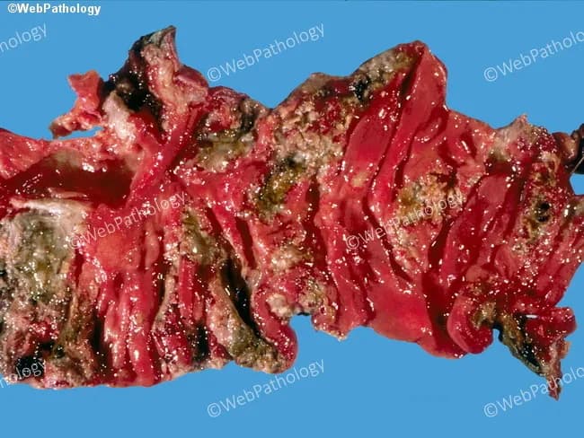 This gross pathology image depicts a colectomy specimen from a patient with Entamoeba histolytica-associated amebic colitis. The colon shows extensive mucosal ulceration with coalescing, serpiginous lesions and an irregular, shaggy fibrinopurulent exudate adherent to the mucosal surface. The involved segments include the cecum and ascending colon, consistent with the common distribution of amebic infection; in severe disease the ileum may be involved though not evident here. The mucosa is friable, erythematous, and eroded with necrotic debris; hemorrhagic areas reflect microvascular injury. This gross pattern can mimic other ulcerative colitides, particularly inflammatory bowel disease, but coarse ulcer margins and exudate are suggestive of amoebic colitis. Clinically, amebiasis presents with abdominal pain, dysentery, weight loss, and may progress to fulminant colitis, megacolon, or perforation. Definitive diagnosis requires histological demonstration of Entamoeba histolytica trophozoites, often with ingested red blood cells, in colonic tissue, or molecular/serologic evidence. Management hinges on anti-amoebic therapy (metronidazole followed by luminal agents) and surgical intervention in complications such as perforation or necrosis. This image highlights a severe surgical specimen with coalescent ulcers and a shaggy exudate that correlates with profound inflammatory destruction and potential life-threatening complications. Correlation with serology or tissue histology confirms amoebic etiology and guides therapy.