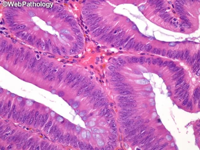 Histopathology-grade colonic adenoma demonstrates low-grade dysplasia characterized by mildly enlarged, elongated, hyperchromatic nuclei that maintain polarity and uniform cytomorphology. Nuclear crowding and pseudostratification are observed, while nucleoli remain inconspicuous. Goblet cell differentiation is reduced, contributing to a more compact mucosal epithelium. Architecturally, the mucosal glands in the polyp are crowded and branched, forming tubular glands with increased gland-to-stroma ratio. The surface epithelium shows longitudinal orientation and slight loss of mucinous content, corresponding to decreased goblet cell density. Despite these changes, cytologic atypia is limited, and invasion is not evident. The image represents a formalin-fixed, paraffin-embedded colonic mucosa section stained with Hematoxylin and Eosin, highlighting small, dysplastic crypts rising above adjacent non-neoplastic mucosa. This histology corresponds to a low-grade dysplasia category (mild-to-moderate) as part of colonic adenoma grading, with the alternative high-grade category including severe dysplasia and carcinoma in situ. Clinically, recognizing low-grade vs high-grade dysplasia influences surveillance intervals, polypectomy strategy, and cancer risk stratification. In a diagnostic workup, these features guide decisions about endoscopic removal, histologic follow-up, and correlation with endoscopic appearance to rule out invasive carcinoma. This description supports precise labeling of lesion grade, informs management planning, and facilitates standardized reporting in multidisciplinary tumor boards and pathology education globally.